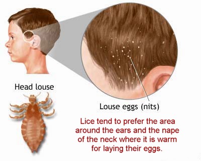 Smaac How To Get Rid Of Lice At Home Fast