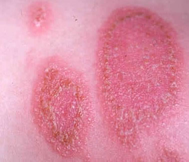 Picture of Ringworm