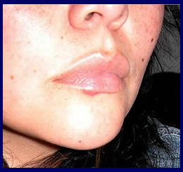 abreva cold sore treatment