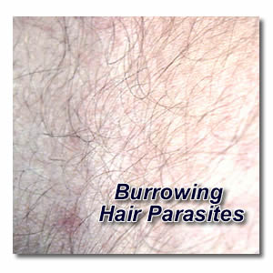 burrowing hair parasites