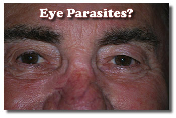 Husband With Eye Parasites