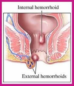 home remedies for hemorrhoids