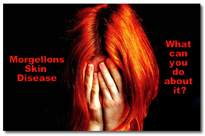 How To Deal With Morgellons Skin Disease
