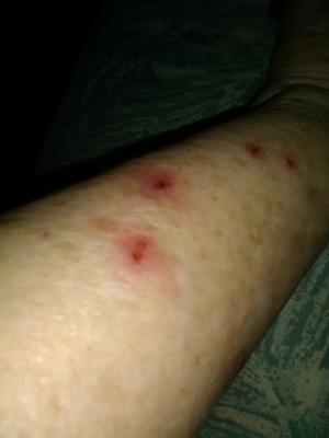 These Are Some Of The Sores On My Legs