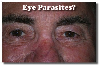 Husband With Eye Parasites